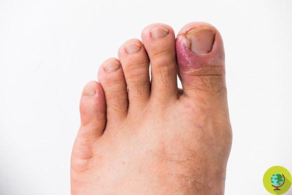 Desde el talón agrietado hasta la hinchazón, ¿qué dicen tus pies sobre tu salud?
