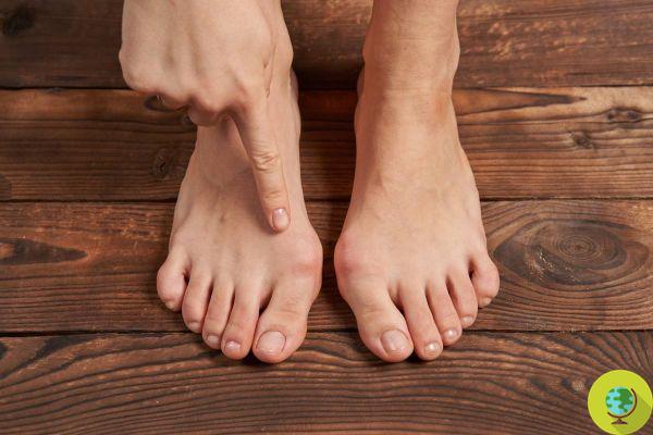 Du talon fissuré au gonflement, que disent vos pieds de votre santé ?