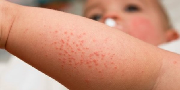 Atopic dermatitis: symptoms, causes and effective remedies