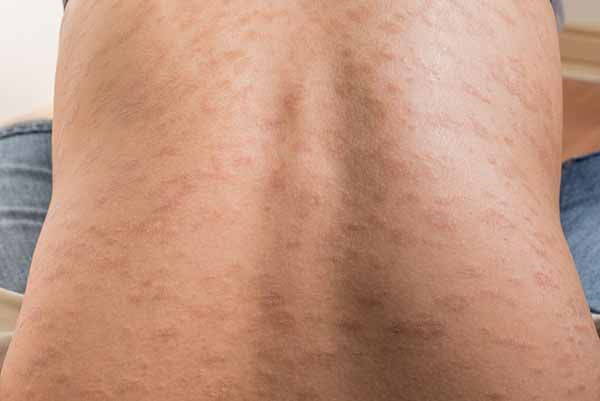 Urticaria: causes, symptoms, natural remedies and how to recognize it (photo)