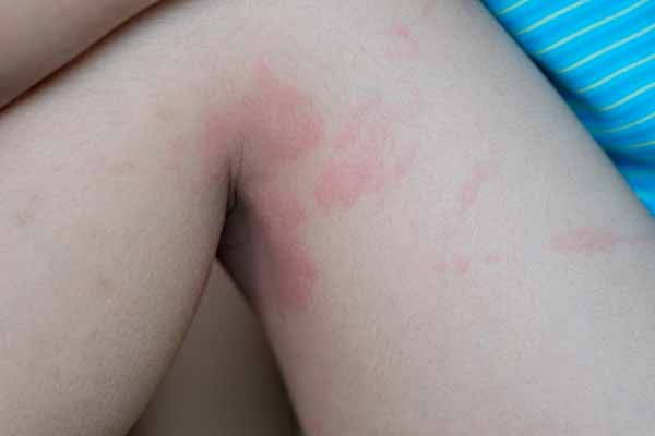 Urticaria: causes, symptoms, natural remedies and how to recognize it (photo)