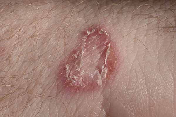 Mycosis: causes, types and all the really effective natural treatments