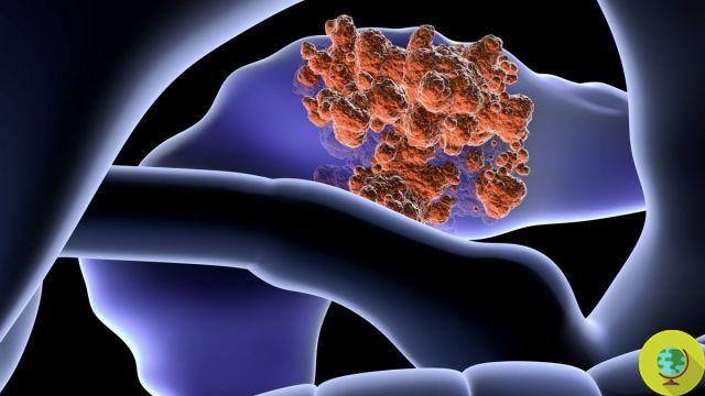 Câncer de pâncreas: Este sinal em suas fezes pode ser um alerta que não deve ser subestimado