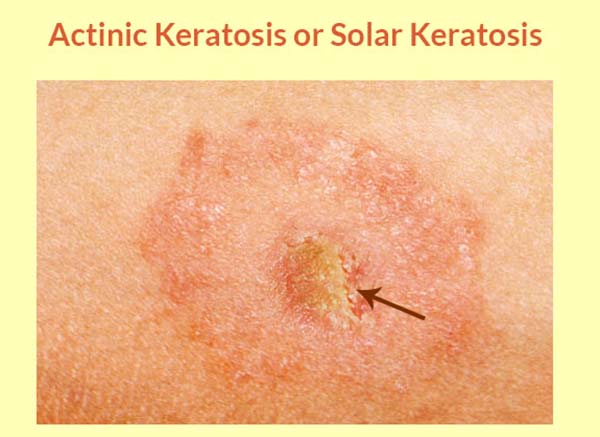 Actinic keratosis: symptoms, causes and all the risks