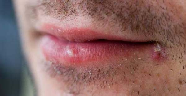 Herpes: types, symptoms and natural remedies