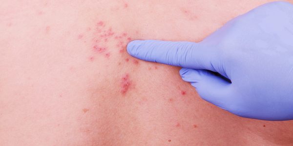Herpes: types, symptoms and natural remedies
