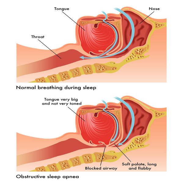 Sleep apnea: causes, symptoms, consequences and remedies
