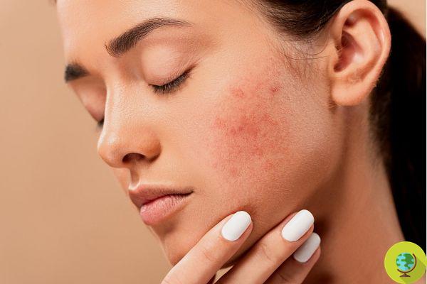 Acne e irritação da máscara: dicas e truques para evitar problemas com a pele