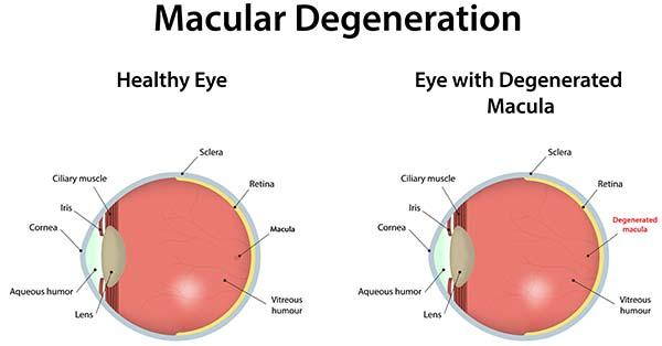 Maculopathy: what it is, symptoms and treatments