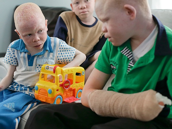 African albino children: from persecution to a new life, thanks to prostheses (PHOTO)