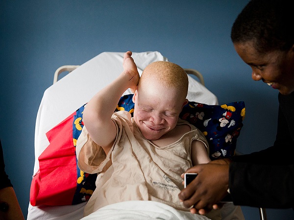 Crianças africanas albinas: da perseguição a uma nova vida, graças às próteses (FOTO)