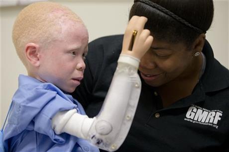 Crianças africanas albinas: da perseguição a uma nova vida, graças às próteses (FOTO)