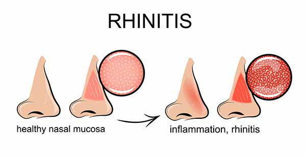 Rhinitis: what it is, symptoms, causes and natural remedies