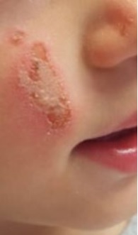 Pulseras repelentes de mosquitos: posibles riesgos para bebés y niños pequeños. La alarma de la ANSES
