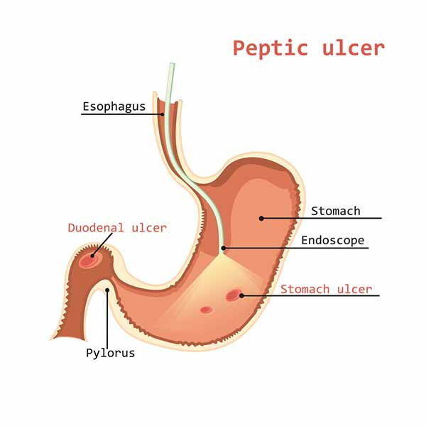 Ulcer: symptoms, causes and diet to protect the stomach