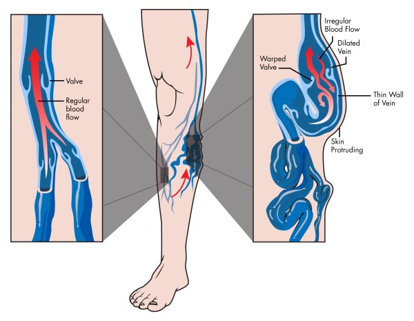 Varicose veins: 10 natural remedies to relieve symptoms and improve circulation