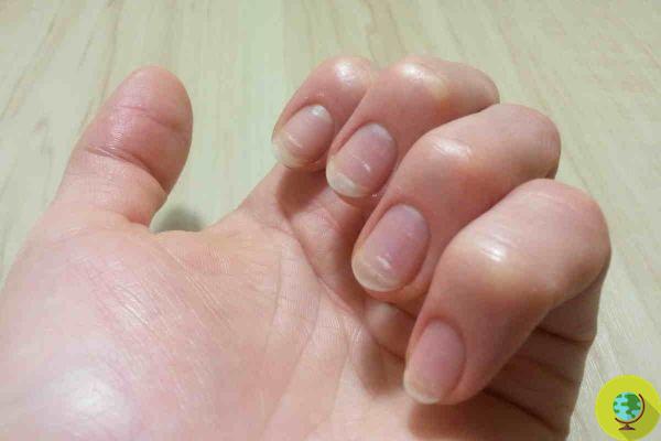 Anemia, do not underestimate this sign on your nails: it could be a symptom of an iron deficiency