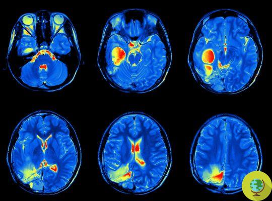 Autism: can be diagnosed as early as 6 months with magnetic resonance imaging