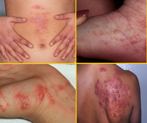 Scabies: symptoms and how to recognize it (pictures)