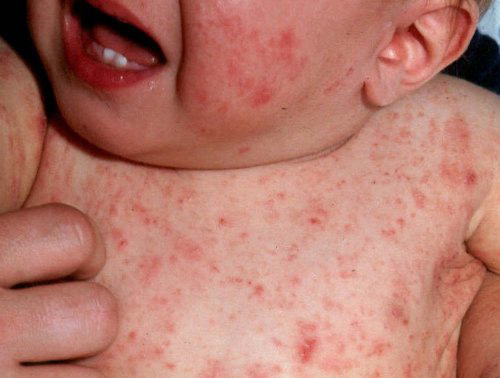 Scabies: symptoms and how to recognize it (pictures)