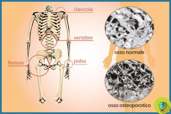 Osteoporose: 5 maus hábitos diários que podem causar perda de cálcio