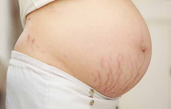 Stretch marks: causes, how to prevent them, treatments and natural remedies