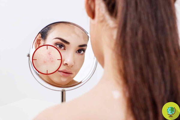 Do-it-yourself remedies: 6 tips to get rid of pimples quickly