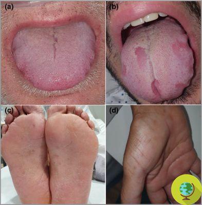 Alterations of the tongue (but also of the hands and feet) are early symptoms of Covid-19. The Spanish study