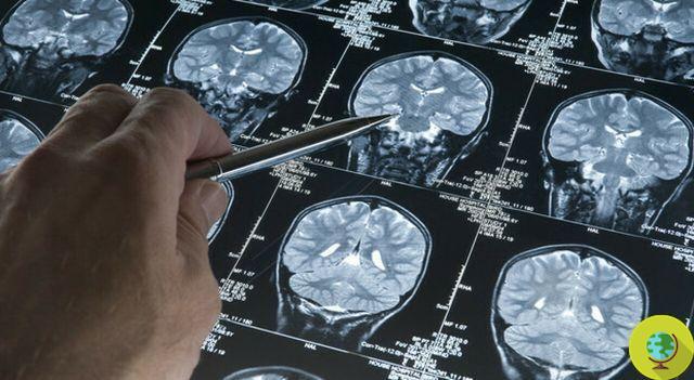 Tumor cerebral: 'chave para acessar' encontrado para curar a forma mais grave, glioblastloma