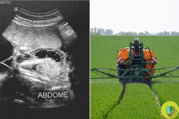 One abortion for every four pregnant women: the city where glyphosate kills those who are not born