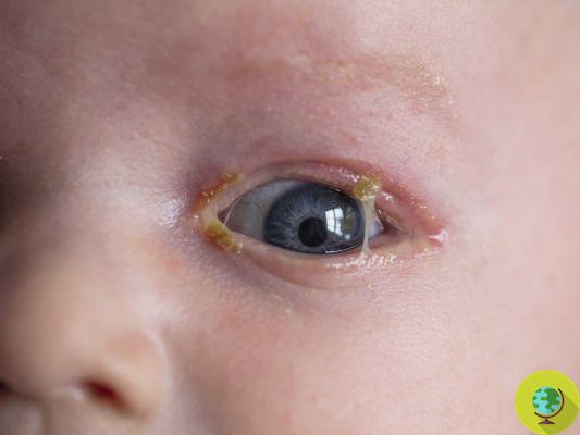 Conjuntivitis: síntomas y remedios en niños y bebés