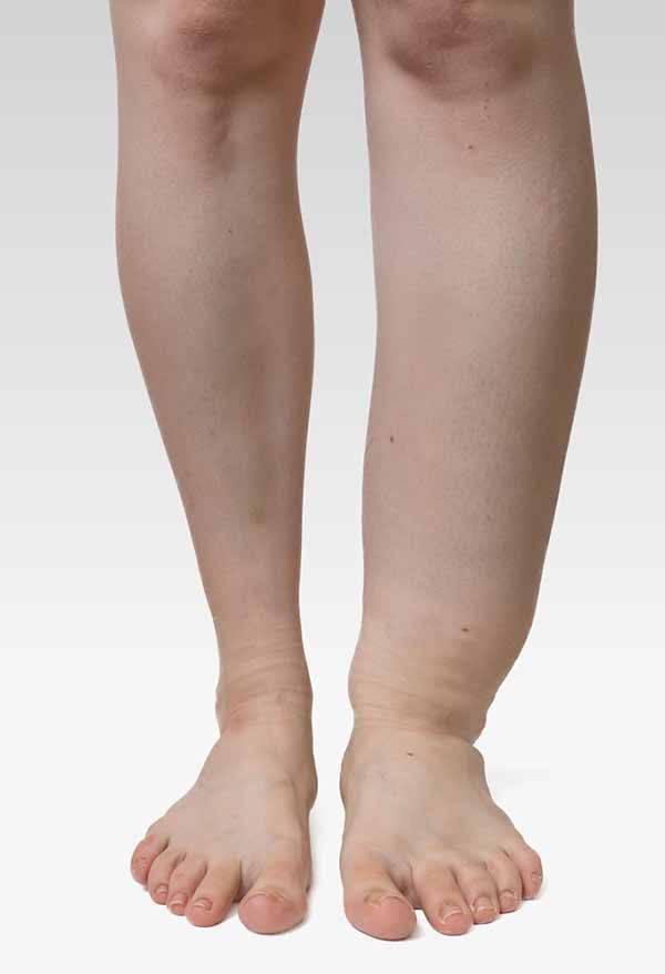 Edema: symptoms, causes, consequences and treatment