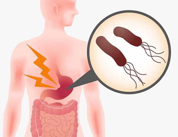 Helicobacter pylori: causes, contagion, symptoms and diet to follow