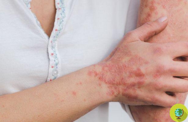 Is there a psoriasis diet that helps manage symptoms?
