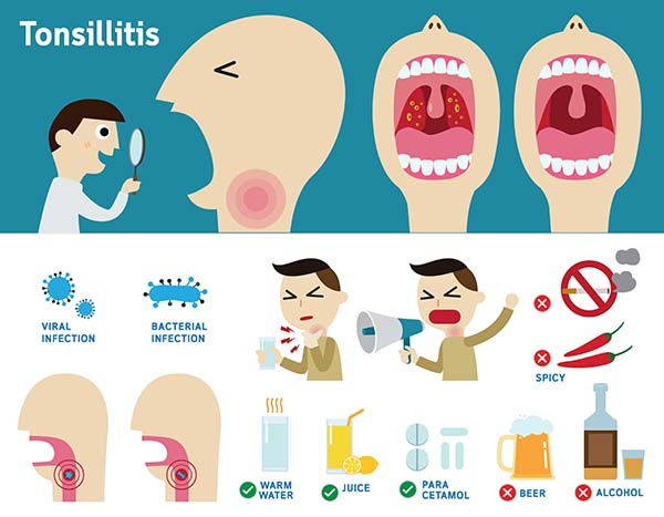 Tonsillitis: symptoms, natural remedies and what to eat