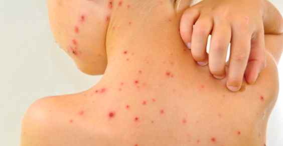 Chickenpox: symptoms, contagion, duration and remedies to relieve the discomfort (photo)
