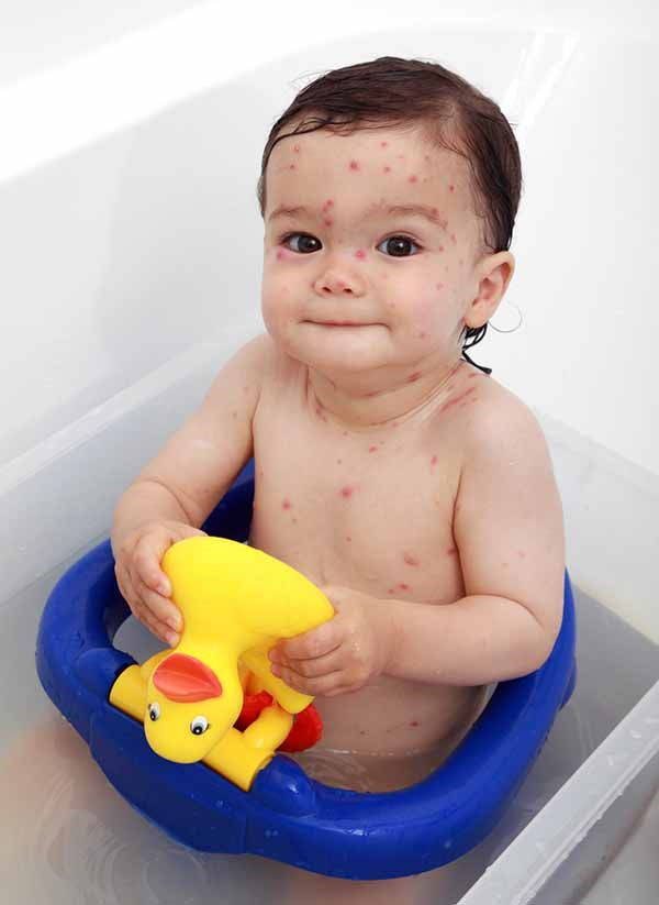 Chickenpox: symptoms, contagion, duration and remedies to relieve the discomfort (photo)