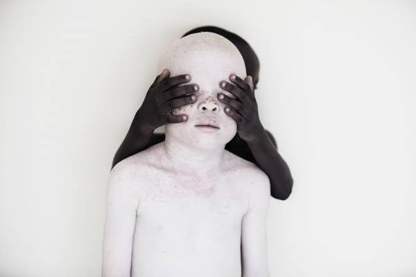 Las maravillosas tomas para denunciar la masacre silenciosa de niños albinos africanos
