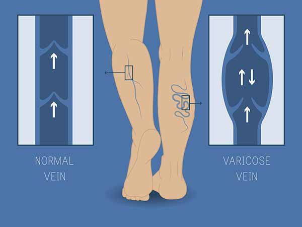 Varicose veins: causes, how to prevent them and effective remedies