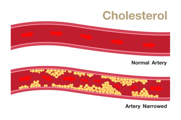 High cholesterol: how to naturally reduce it by 20% in just three months
