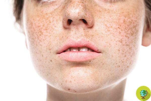 Taches solaires sur la peau : comment les prévenir et les traiter naturellement