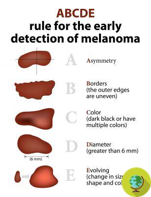 Câncer de pele: se você tiver uma verruga suspeita, este método simples ajudará você a descobrir se é um melanoma
