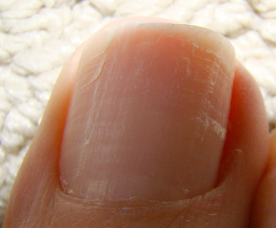 Flaking nails: causes and natural remedies