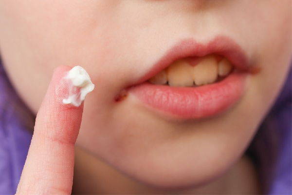 Mouth sores: symptoms, causes and possible remedies