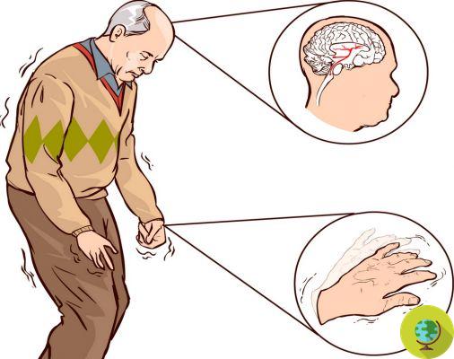 Parkinson's disease: 10 most common symptoms