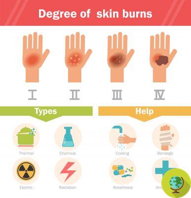 Burns: natural home remedies for minor burns or sunburns