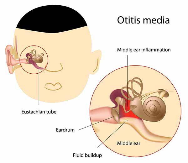 Otitis: Symptoms, Causes, and Natural Cures in Adults and Children
