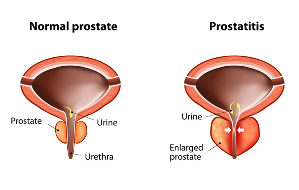 Prostate: 20 symptoms not to be underestimated