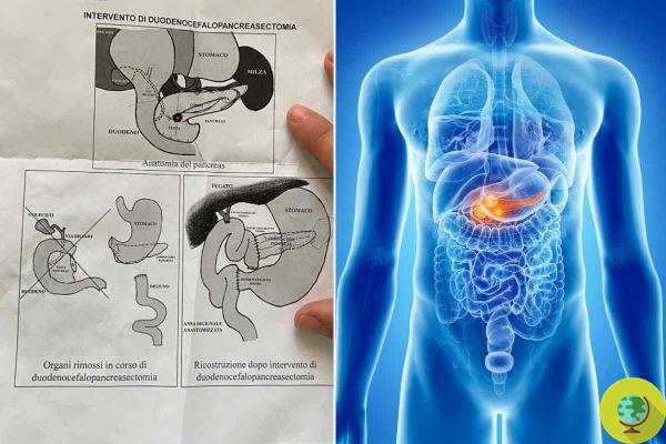 Tumor neuroendócrino pancreático: sintomas que não devem ser subestimados