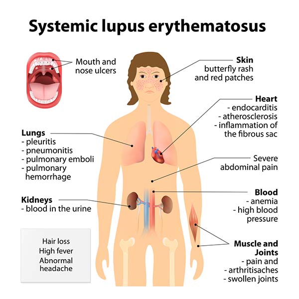 Systemic lupus erythematosus: what it is, symptoms and treatment